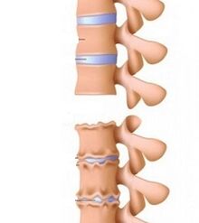 Fáze ramp osteochondrosy krku
