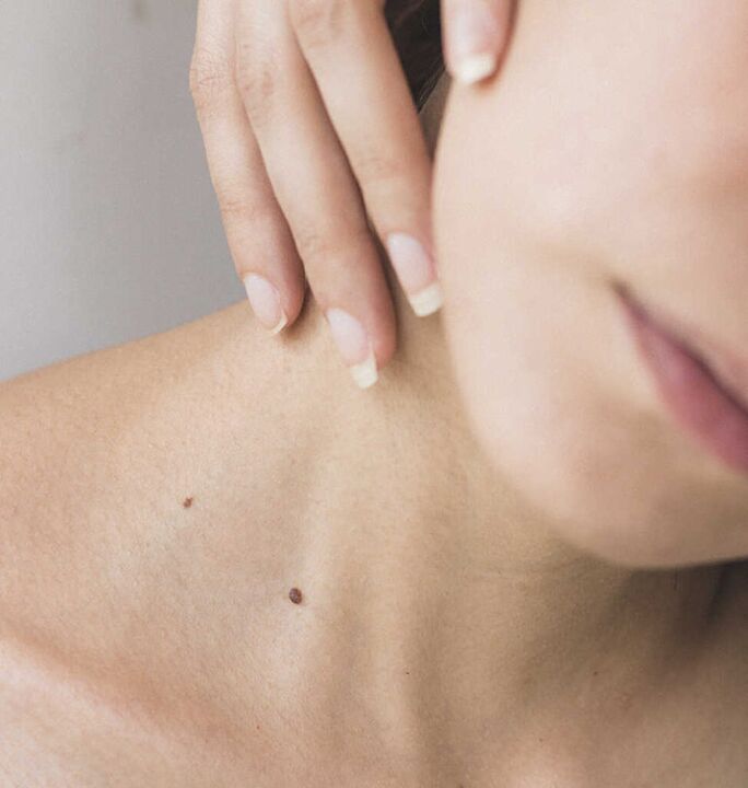 Ztuhlost v krku je jedním z příznaků počátečního stadia osteochondrózy krční páteře