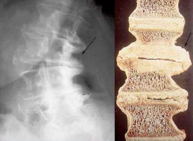 poškození obratlů při hrudní osteochondróze