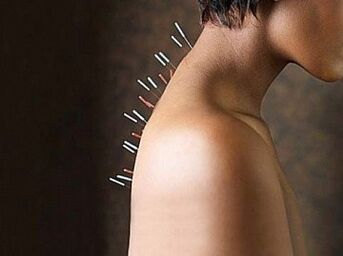 Reflexoterapie je účinná metoda léčby cervikální osteochondrózy