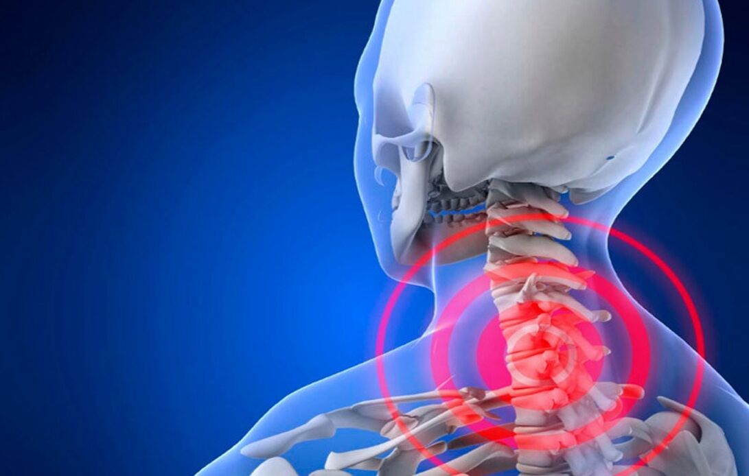 osteochondróza krční páteře